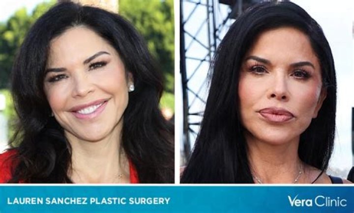 
Lauren Sanchez Before Surgery – Did She Underwent Plastic Surgery? 